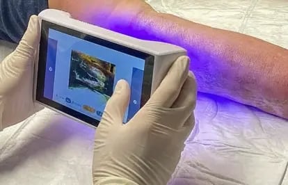 Digitale Wunddoku und BakterienScan in Anwendung