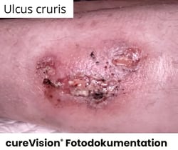 Ulcus_Unbearbeitet Ulcus_Unbearbeitet